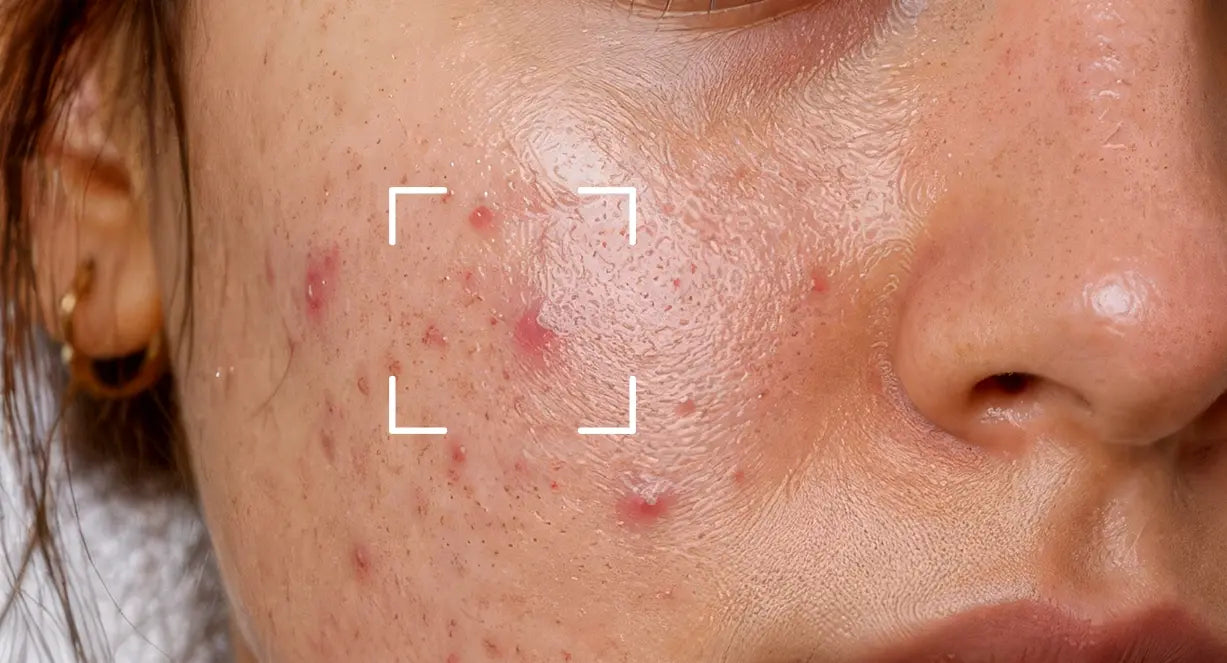Acne