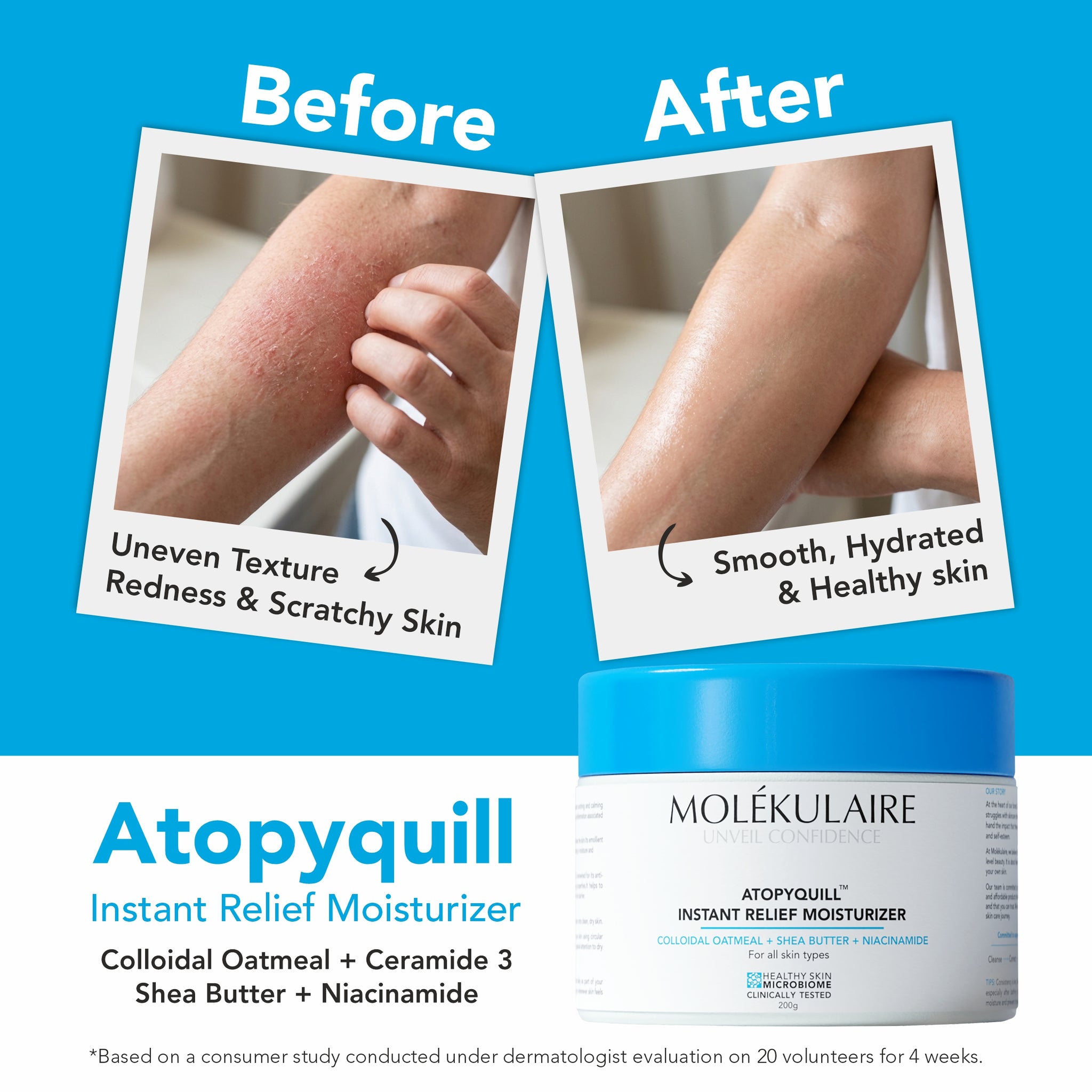 Atopyquill Instant Relief Moisturizer 200g